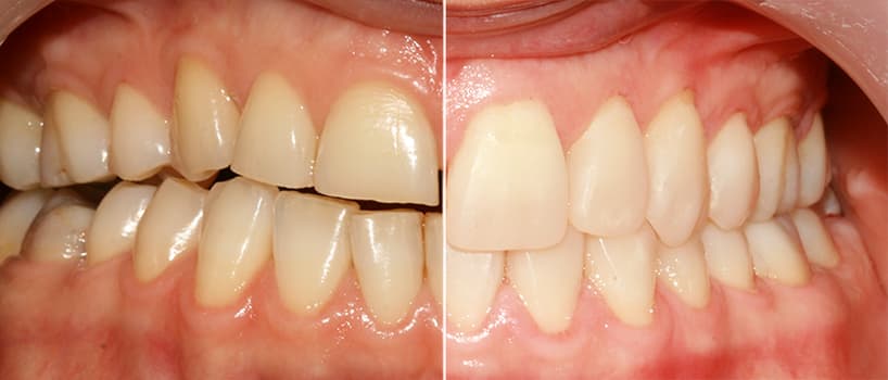 Desgastes Dentários