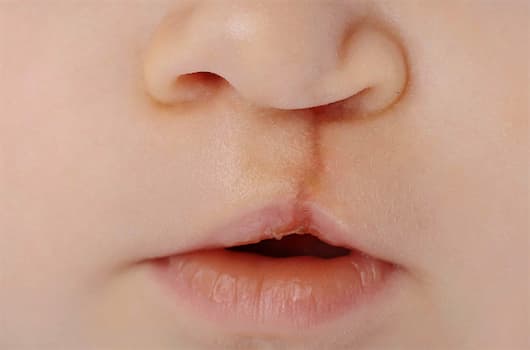 Fendas Labiais e Palatinas